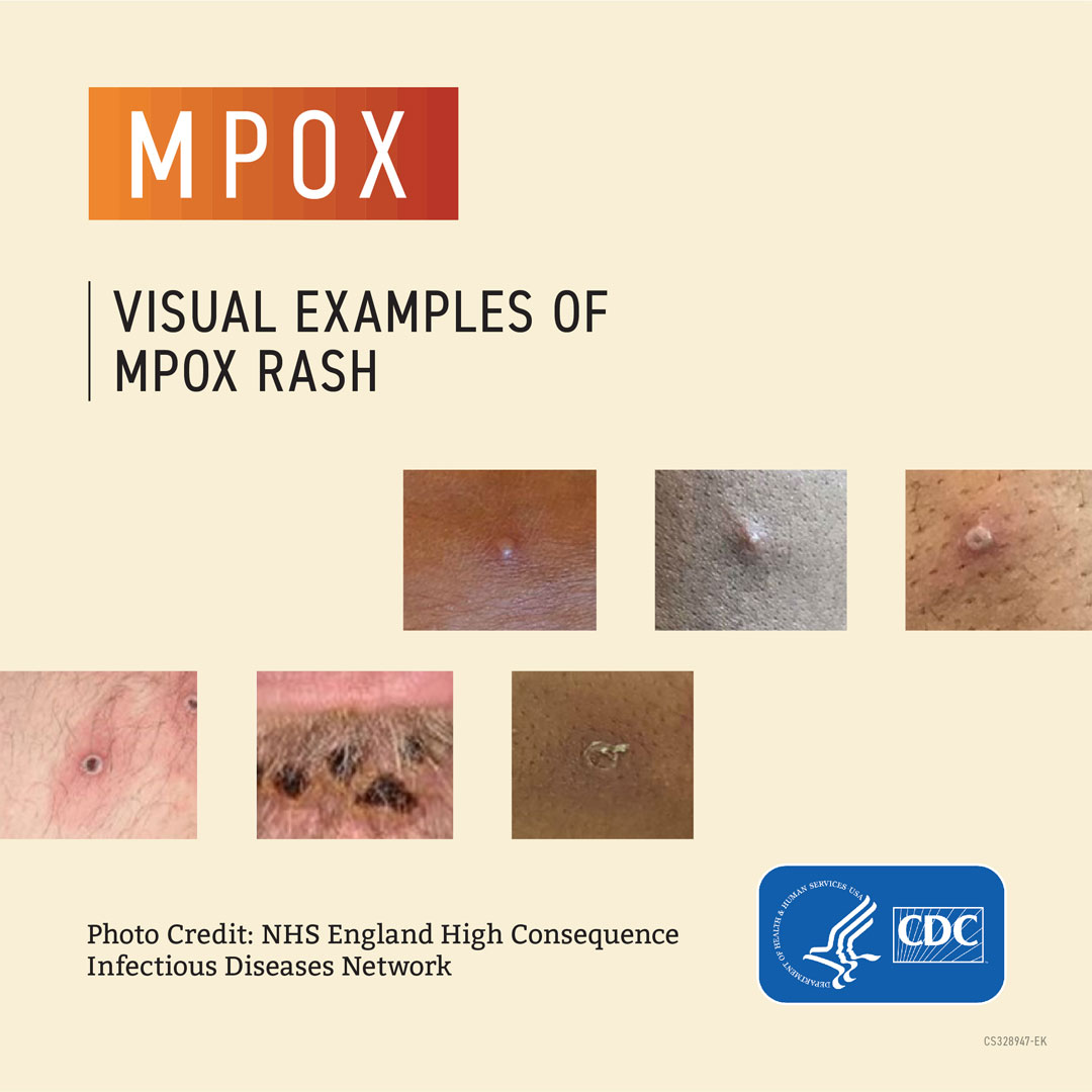 mpox examples