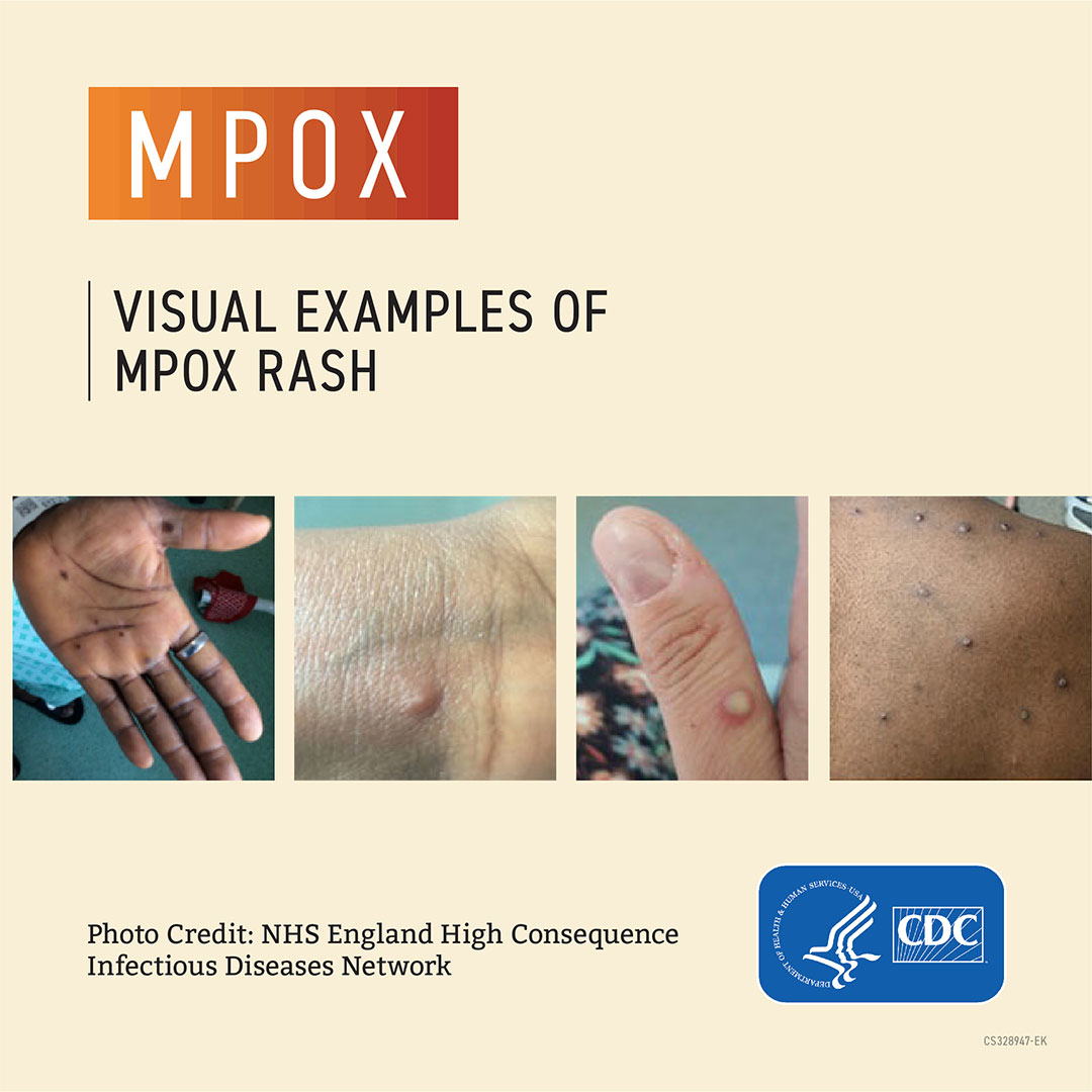 Visual examples of mpox rash