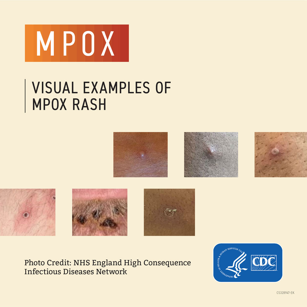 visual examples of mpox rash