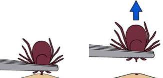 Tick Removal