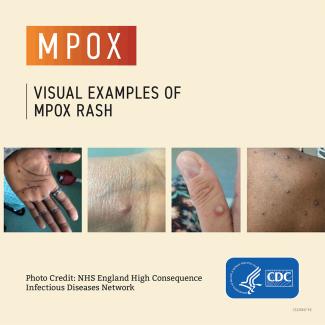 mpox poster 1