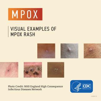 mpox  poster 2